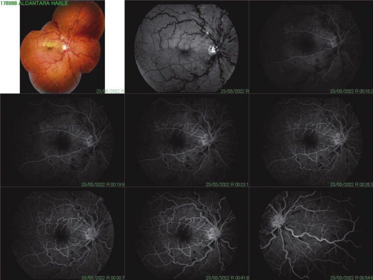 Oclusión mixta de la vena central de la retina y de rama de la arteria