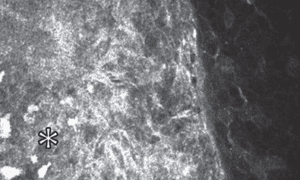 Diagnósticos de tumor de superficie ocular