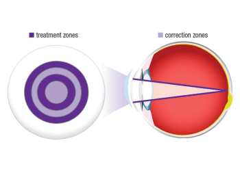 Una revisión a los avances en el manejo de la miopía