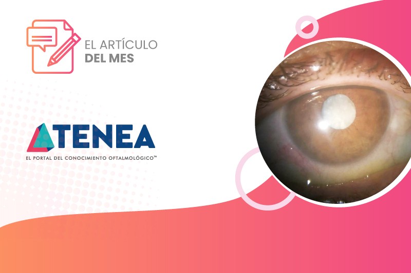 iridosquisis un hallazgo 800x533 web