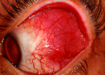 El enrojecimiento que no desaparece