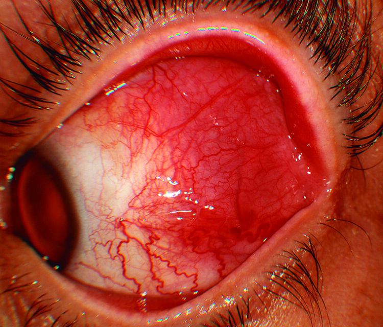 El enrojecimiento que no desaparece