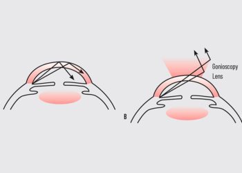 La gonioscopia y el arte de captar los ángulos estrechos