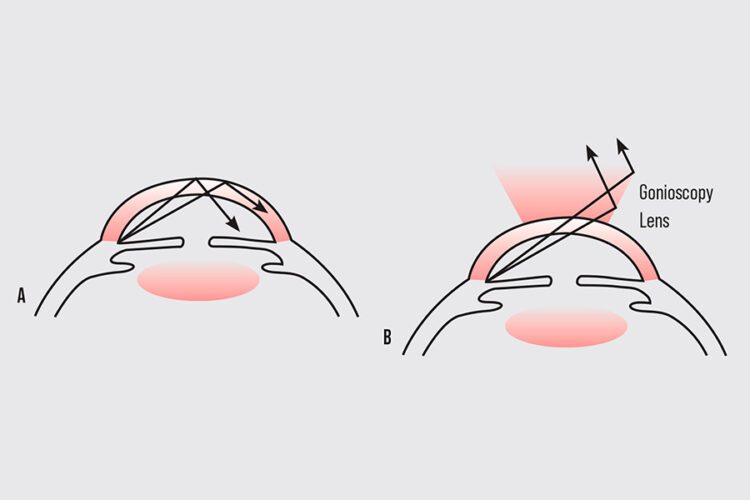 La gonioscopia y el arte de captar los ángulos estrechos