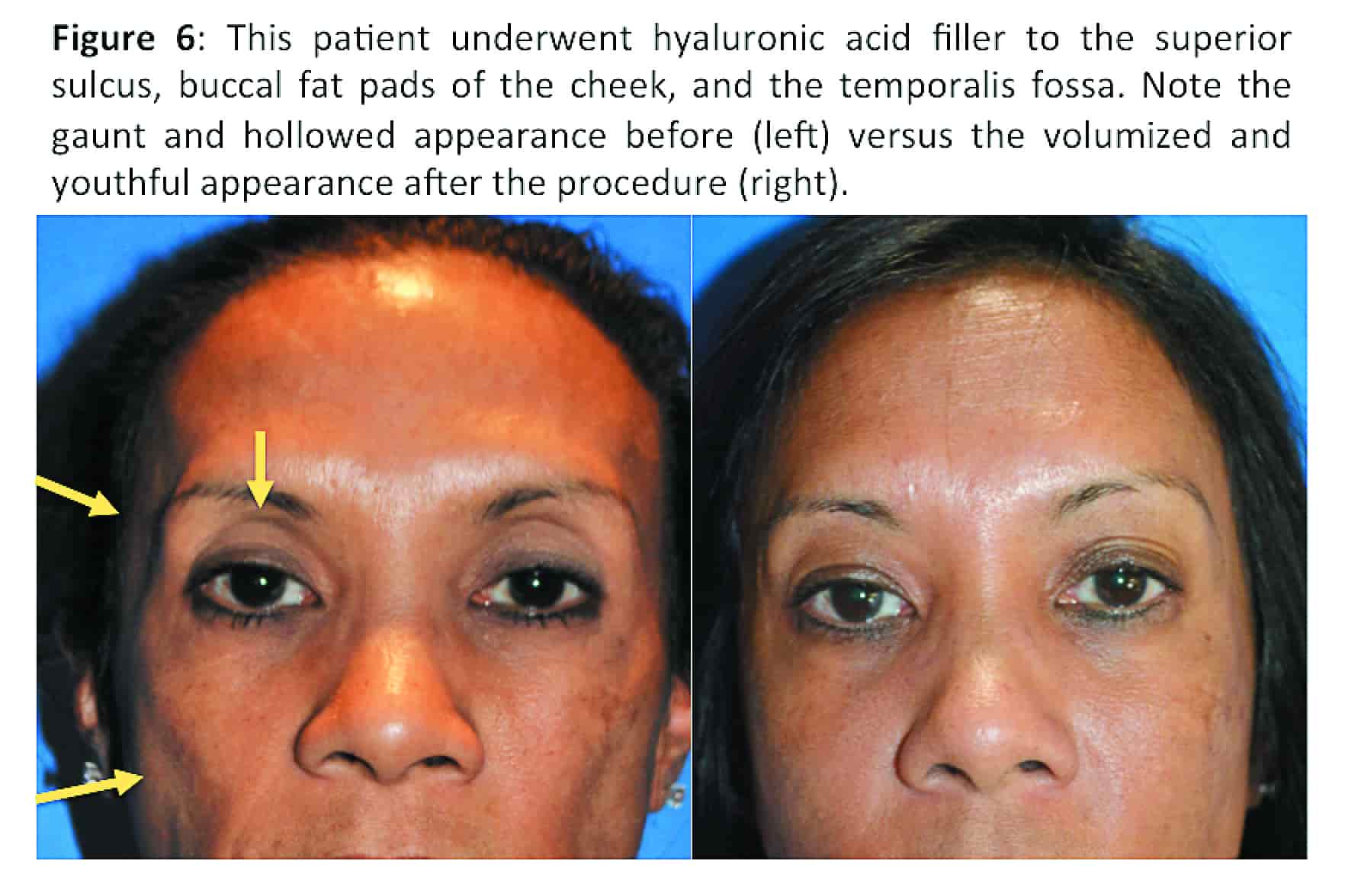 El origen del ácido hialurónico para tratar el ojo seco - Oftalmologo Vigo