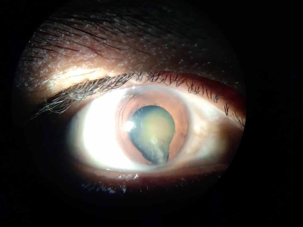 Imagen de desprendimiento de retina