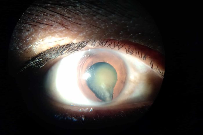 Imagen de desprendimiento de retina
