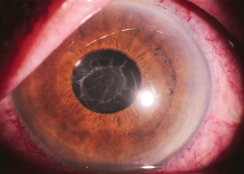 Cómo manejar la inflamación post operación