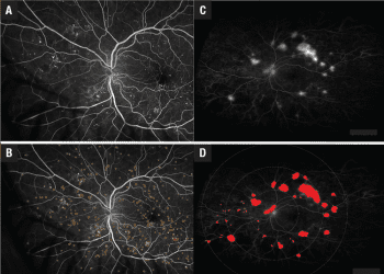 ¿Cómo la IA puede afectar la práctica de la retina?