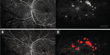 ¿Cómo la IA puede afectar la práctica de la retina?