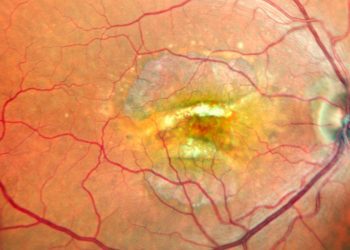 Desgarro doble de epitelio pigmentario de la retina evaluado mediante imagen multimodal