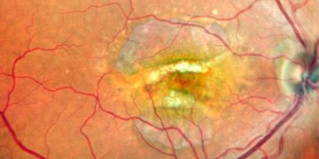 Desgarro doble de epitelio pigmentario de la retina evaluado mediante imagen multimodal