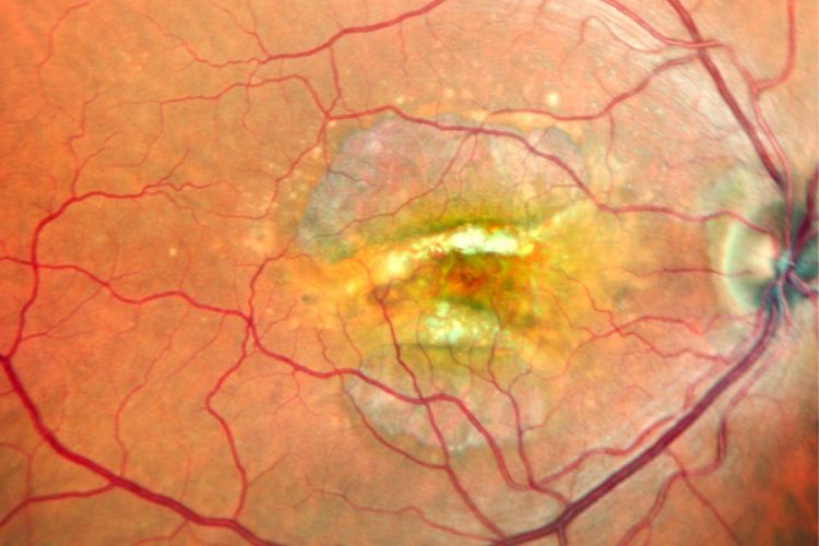 Desgarro doble de epitelio pigmentario de la retina evaluado mediante imagen multimodal