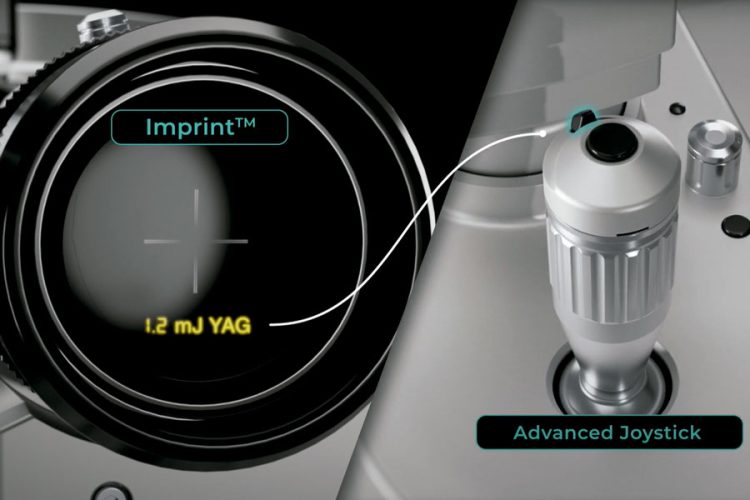 Capsulotomía posterior en la práctica diaria de la catarata