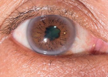 Fármacos sistémicos y cataratas