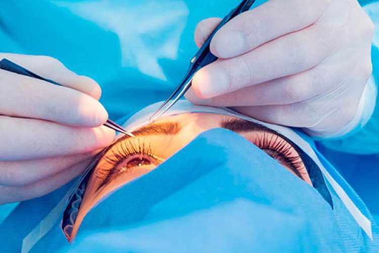 “Cirugía glauco-preventiva” ¿qué es, qué significa?