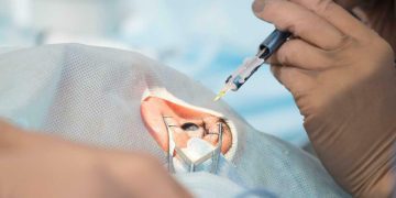 Lecciones sobre la extracción de cristalino transparente