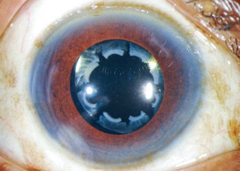 Contracción de la cápsula anterior asociado a dolor ocular bilateral con lentes intraoculares hidrofóbicos