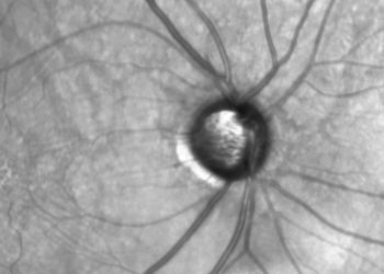 Manejo del glaucoma inducido por esteroides