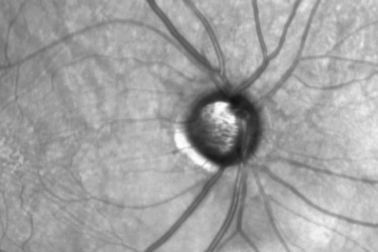 Manejo del glaucoma inducido por esteroides