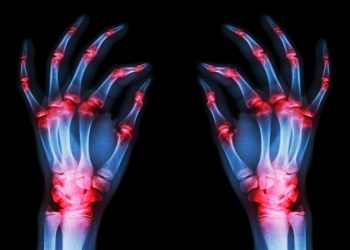 La artritis reumatoide conduce a un mayor riesgo de cataratas y glaucoma