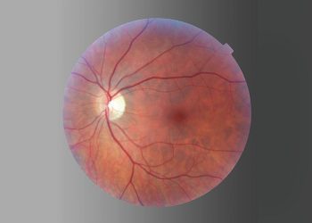 Revisión sobre la reparación del desprendimiento de retina