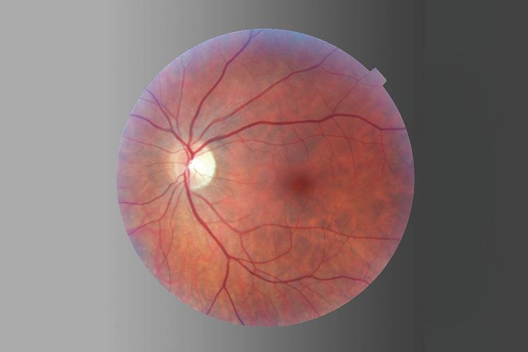 Revisión sobre la reparación del desprendimiento de retina