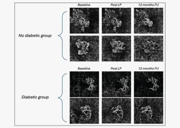 La diabetes podría reducir el efecto de la terapia anti-VEGF en la DMAE