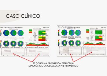 Webinar Norlase: Innovaciones láser para la oftalmología moderna
