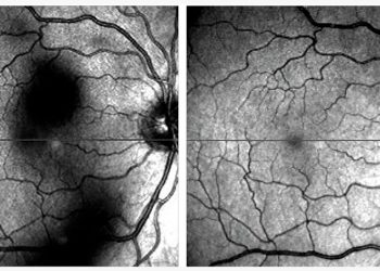 Tratamiento de las condensaciones vítreas: ventajas, inconvenientes y técnicas