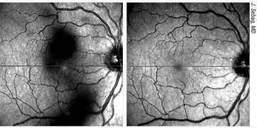 Tratamiento de las condensaciones vítreas: ventajas, inconvenientes y técnicas
