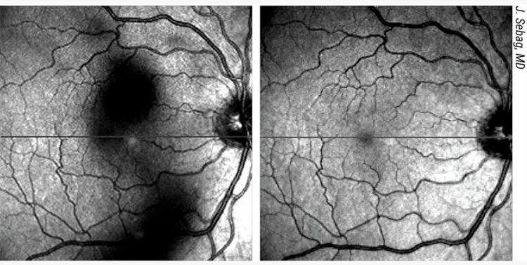 Tratamiento de las condensaciones vítreas: ventajas, inconvenientes y técnicas