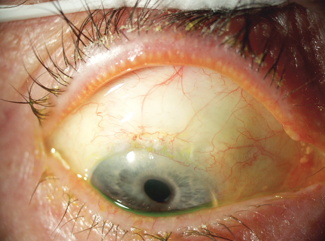 Prevención y manejo de complicaciones de la trabeculectomía – Oftalmólogo  al Día, image size:1288x956