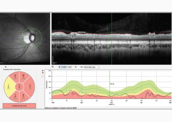 Glaucoma: Detección de artefactos de la OCT