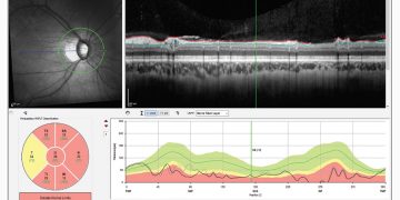 Glaucoma: Detección de artefactos de la OCT