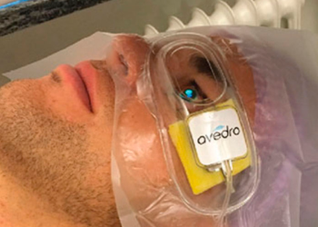 La CXL transepitelial acelerada preserva mejor el grosor corneal que la técnica epi-off