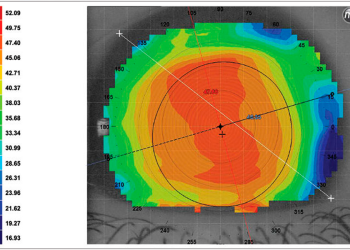 Factores de riesgo asociados a la regresión miópica tras cirugía refractiva: edad avanzada y sexo femenino