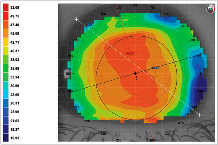 Factores de riesgo asociados a la regresión miópica tras cirugía refractiva: edad avanzada y sexo femenino
