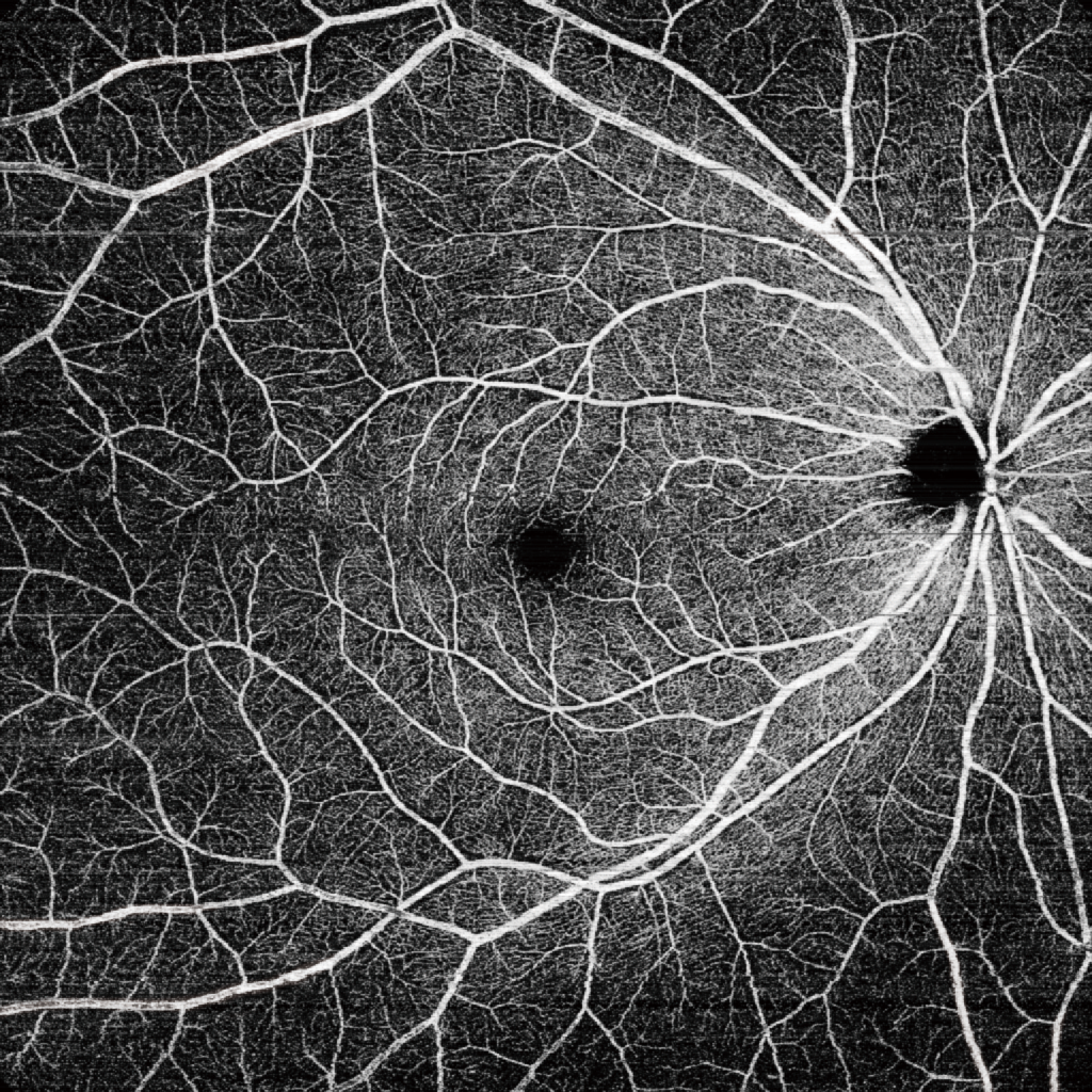 angiografía oct 12 x 12 mm​