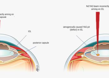 ¿Cuándo es seguro realizar una capsulotomía YAG para la opacificación capsular posterior (PCO)?