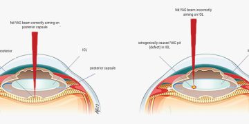 ¿Cuándo es seguro realizar una capsulotomía YAG para la opacificación capsular posterior (PCO)?