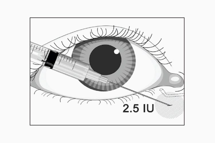 El bótox puede suponer un nuevo avance en el tratamiento del ojo seco