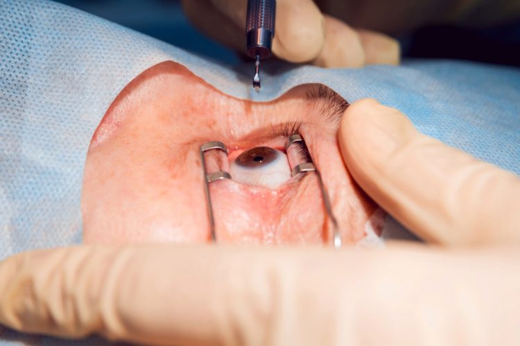 Cómo afrontar vitrectomías anteriores no planificadas