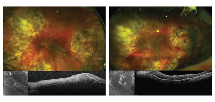 Terapias actuales para la PVR