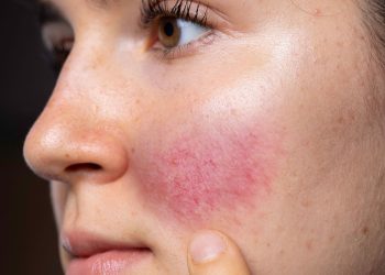 Rosácea ocular como entidad inflamatoria crónica: Revisión integral desde la fisiopatología hasta la intervención clínica