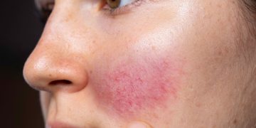 Rosácea ocular como entidad inflamatoria crónica: Revisión integral desde la fisiopatología hasta la intervención clínica