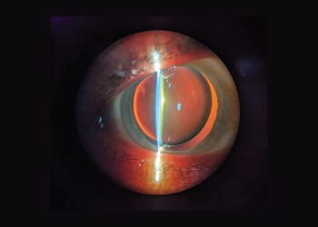 Cirugía de cataratas en ojos con antecedentes retinianos