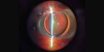 Cirugía de cataratas en ojos con antecedentes retinianos