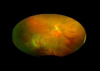 Regresión espontánea de una masa subretiniana periférica: a propósito de un caso de PEHCR