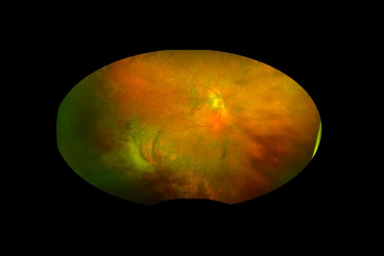 Regresión espontánea de una masa subretiniana periférica: a propósito de un caso de PEHCR